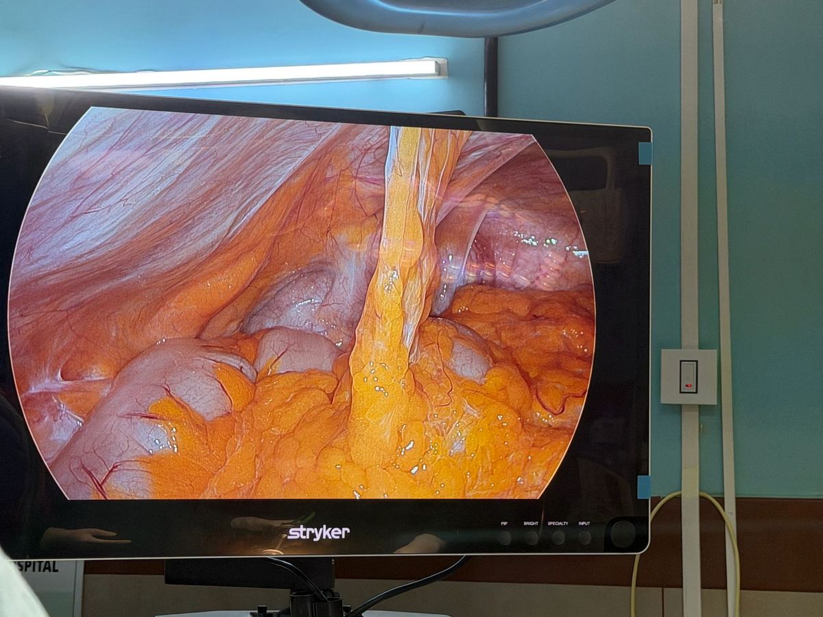 Intraoperative adhesions during oncosurgery